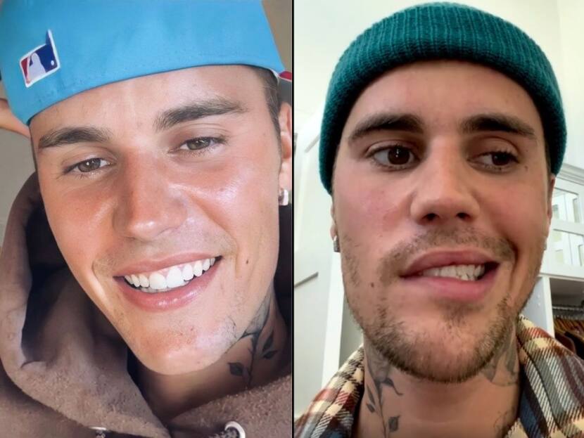 Ramsay Hunt Syndrome? The 'Rare' Condition That Has Left Justin Bieber With Facial Paralysis