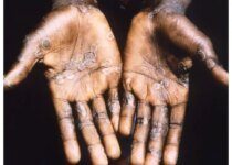 WHO Declares Monkeypox Global Health Emergency As 16K Infections Reported In 75 Countries